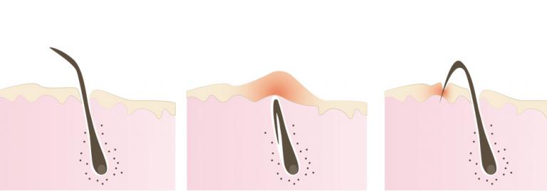 foliculitis-y-depilacion-laser-min.jpg