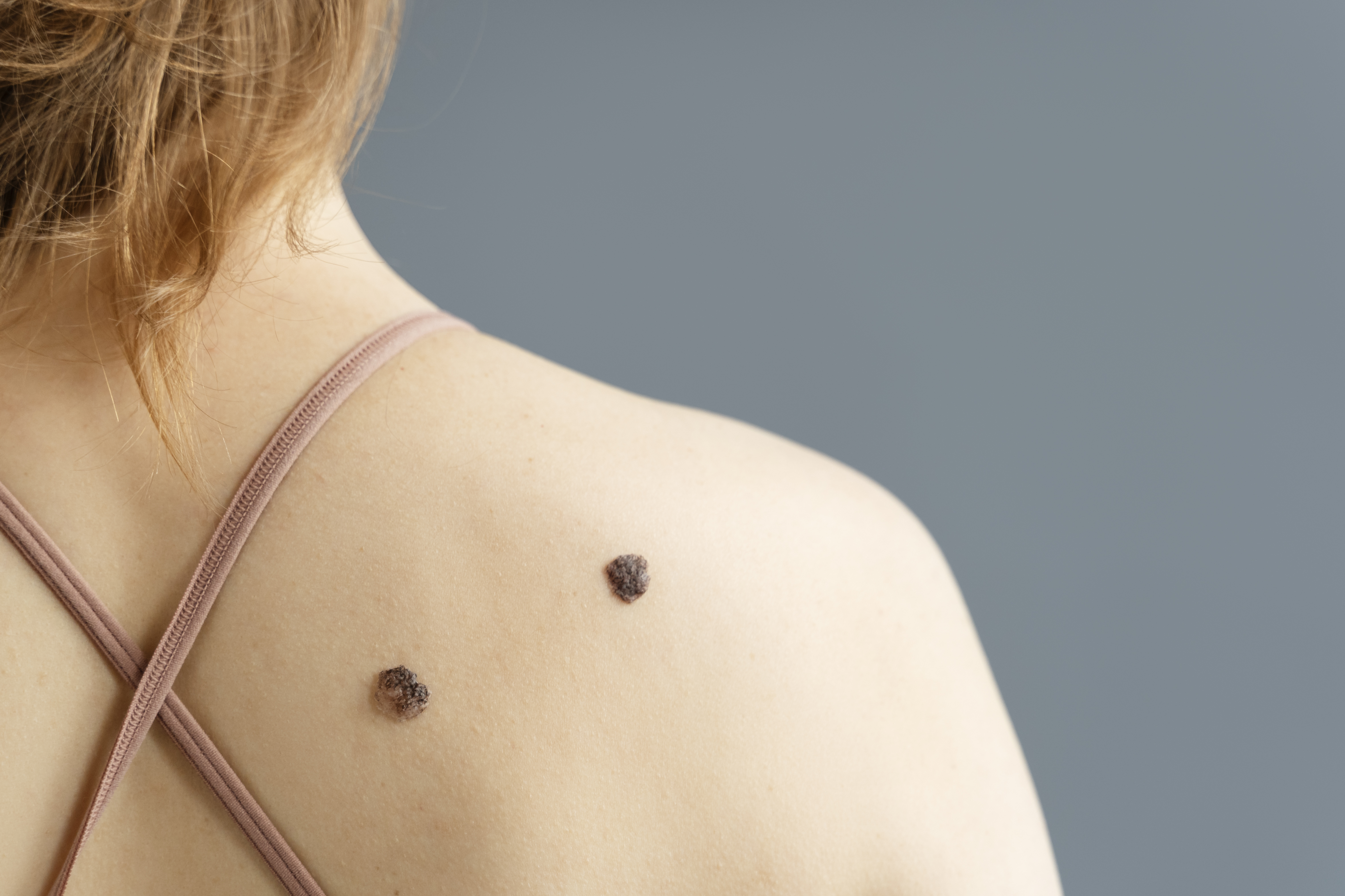 mujer-joven-con-lunares-espalda-vista.jpg
